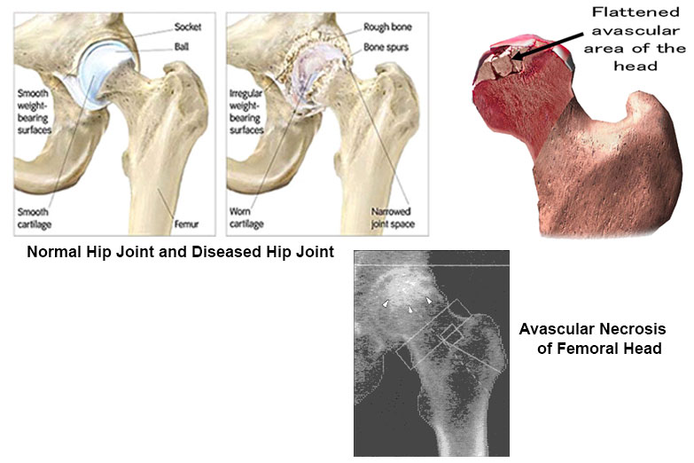 Knee Replacement Surgeon in Kolhapur