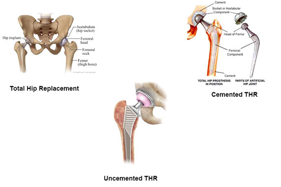 Revision Total Hip Replacement