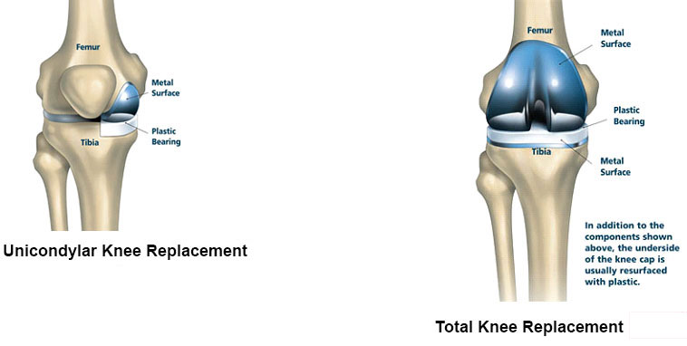 Best Doctor for Total Knee Replacement in Kolhapur 