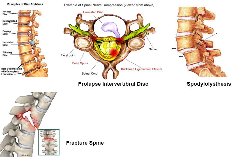 Best Spine Surgeon in Kolhapur